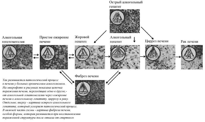 Цепочка алкогольных поражений печени